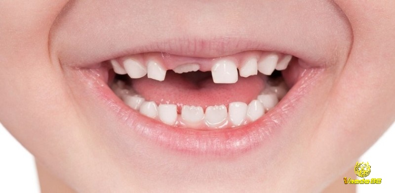 Giấc mơ thấy mình rụng nhiều răng thể hiện cho những lo lắng và bất an của bạn